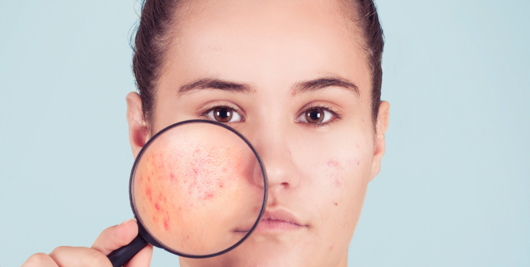 Tips for Adult Acne