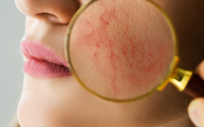 Is Rosacea Stopping You From Putting Your Best Face Forward?