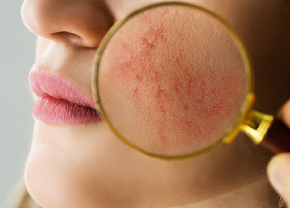 Is Rosacea Stopping You From Putting Your Best Face Forward?